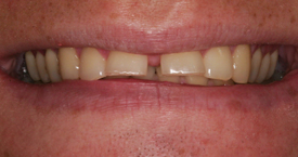 Gaps or Spaces Between Teeth