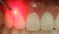 Dental Laser Therapy
